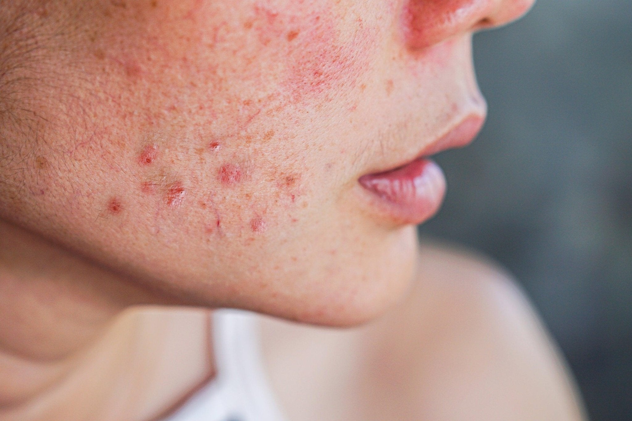 脂性敏感肌とは？ 原因や正しいスキンケア方法を解説 - 【公式サイト】SNOW FOX SKINCARE オンラインショップ